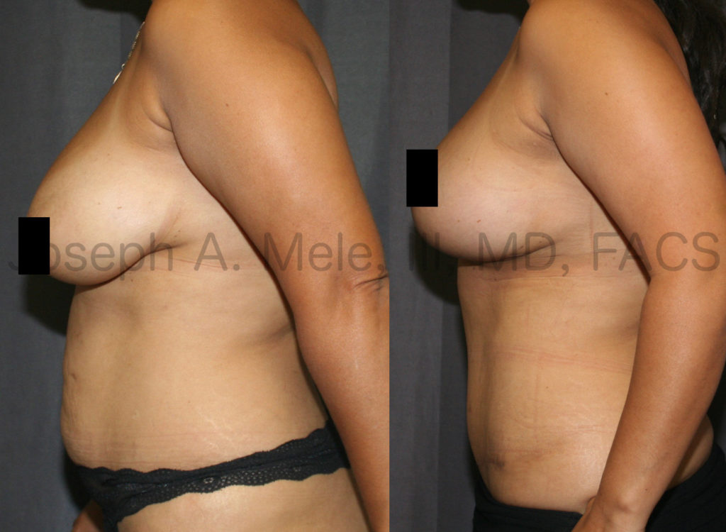 More Mommy Makeover before and afters: Again, Abdominoplasty is combined with Breast Enhancement. In this case, a Breast Lift was combined with a Tummy Tuck for a uplifted, aesthetic result.