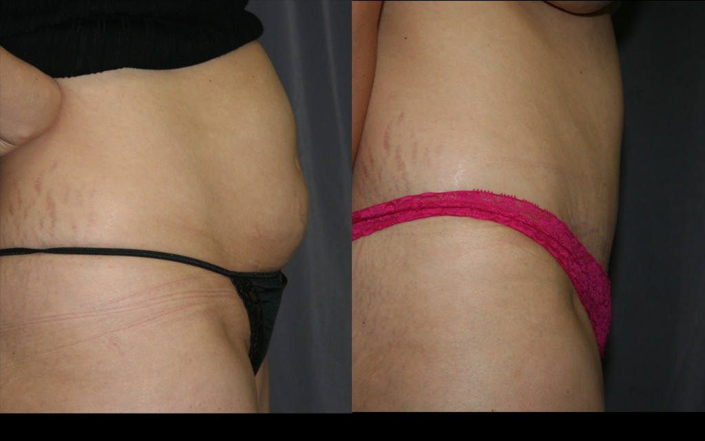 Tummy Tucks (Abdominoplasty)