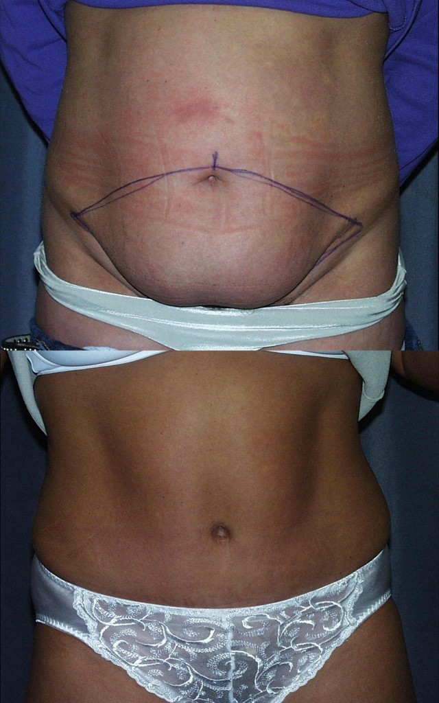 Tummy tuck before and after pictures: The purple ink outlines the skin removed by the abdominoplasty. The internal tightening of the abdominal muscles flattens the belly and bring the rectus muscles back to the middle wear they belong.