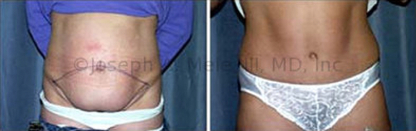 The above Tummy Tuck before and after pictures show where the skin is removed. 