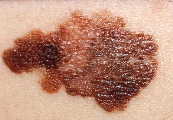 The Typical Melanoma has: A) Asymmetry; B) Borders that are irregular and not smooth; C) Colors that vary from red, white to blue; D) Diameter that is increasing in size. These are the ABCD's of melanoma.
