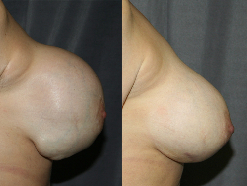 This woman developed a collection of blood (a hematoma) around her ruptured breast implant after trauma. Urgent breast implant replacement was performed before the hematoma became infected or leaked through the skin.