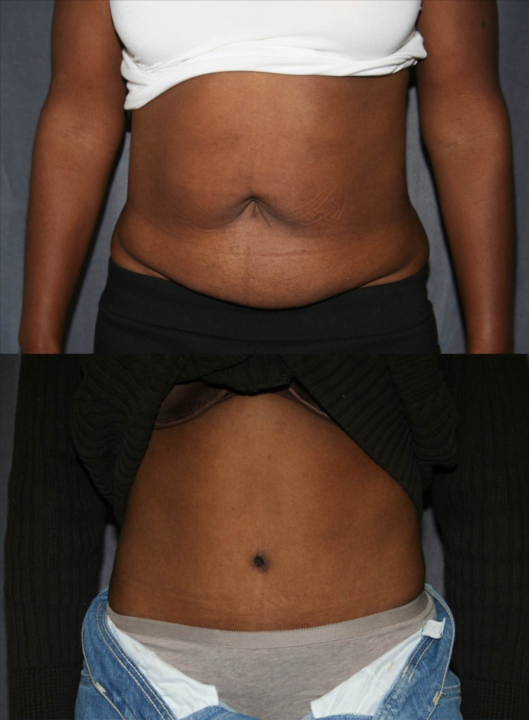 Tummy tuck before and after pictures