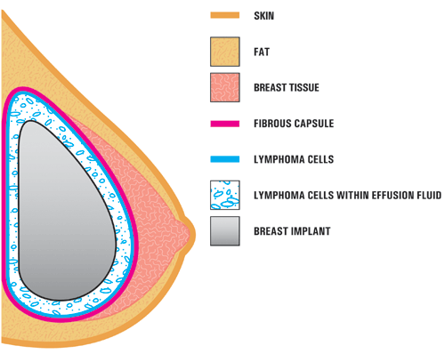 BIA-ALCL seems to form on the surface of textured breast implants. The cells can also be found in the fluid  that accumulates around the breast implant. The bacteria that form a biofilm around the textured implants have been associated with this tumor.