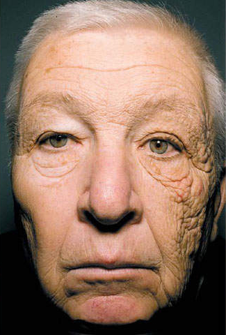 This long haul trucker, famously featured in the New England Journal of Medicine, has unilateral dermatoheliosis, which means one sided sun damage to his skin. With the sun shining through the driver's side window over the years, the left side of his face has received more sun exposure than the right side.