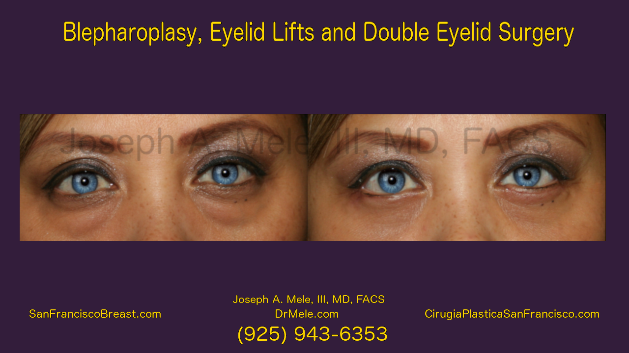 Cosmetic Eyelid Surgery (Blepharoplasty) Video with Before and After Pictures