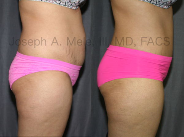 Tummy Tuck, Liposuction, BBL combination before and after pictures - side view