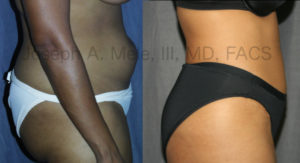 Abdominoplasty (Tummy Tuck) before and after pictures - side view