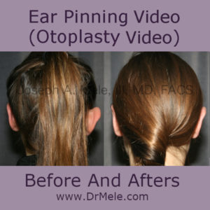 Otoplasty before and after photos for prominent ear pinning