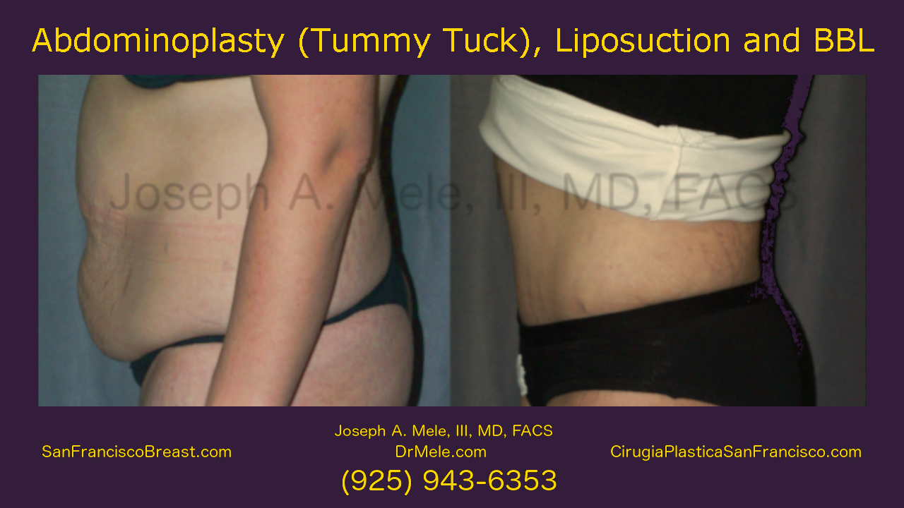 Tummy Tuck (Abdominoplasty) Videos with Before and After Pictures