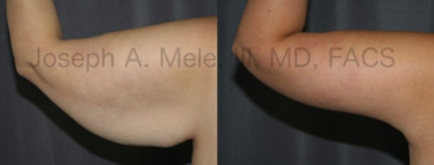 Post Bariatric Plastic Surgery - Arm Lift Brachioplasty