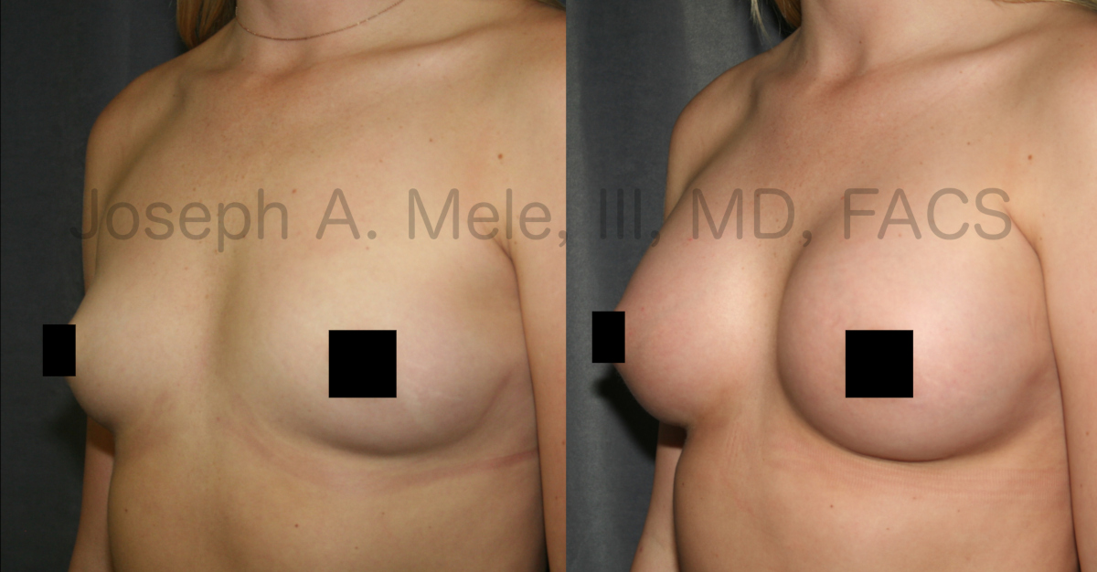 Breast Augmentation with Breast Implants before and after pictures