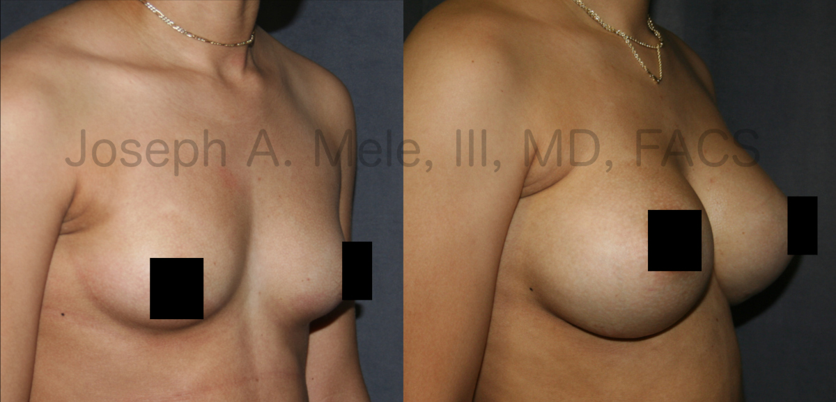 Breast Augmentation with Breast Implants before and after pictures