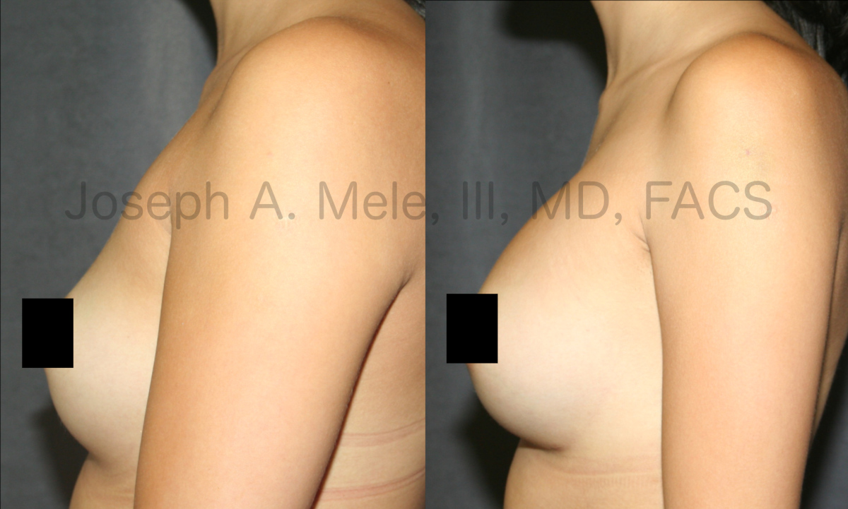 Breast Augmentation with Breast Implants before and after pictures