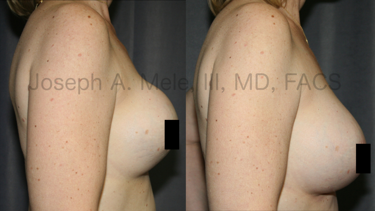 Breast Augmentation with Breast Implants before and after pictures