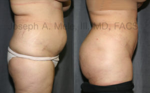 BBL with liposuction before and after pictures.