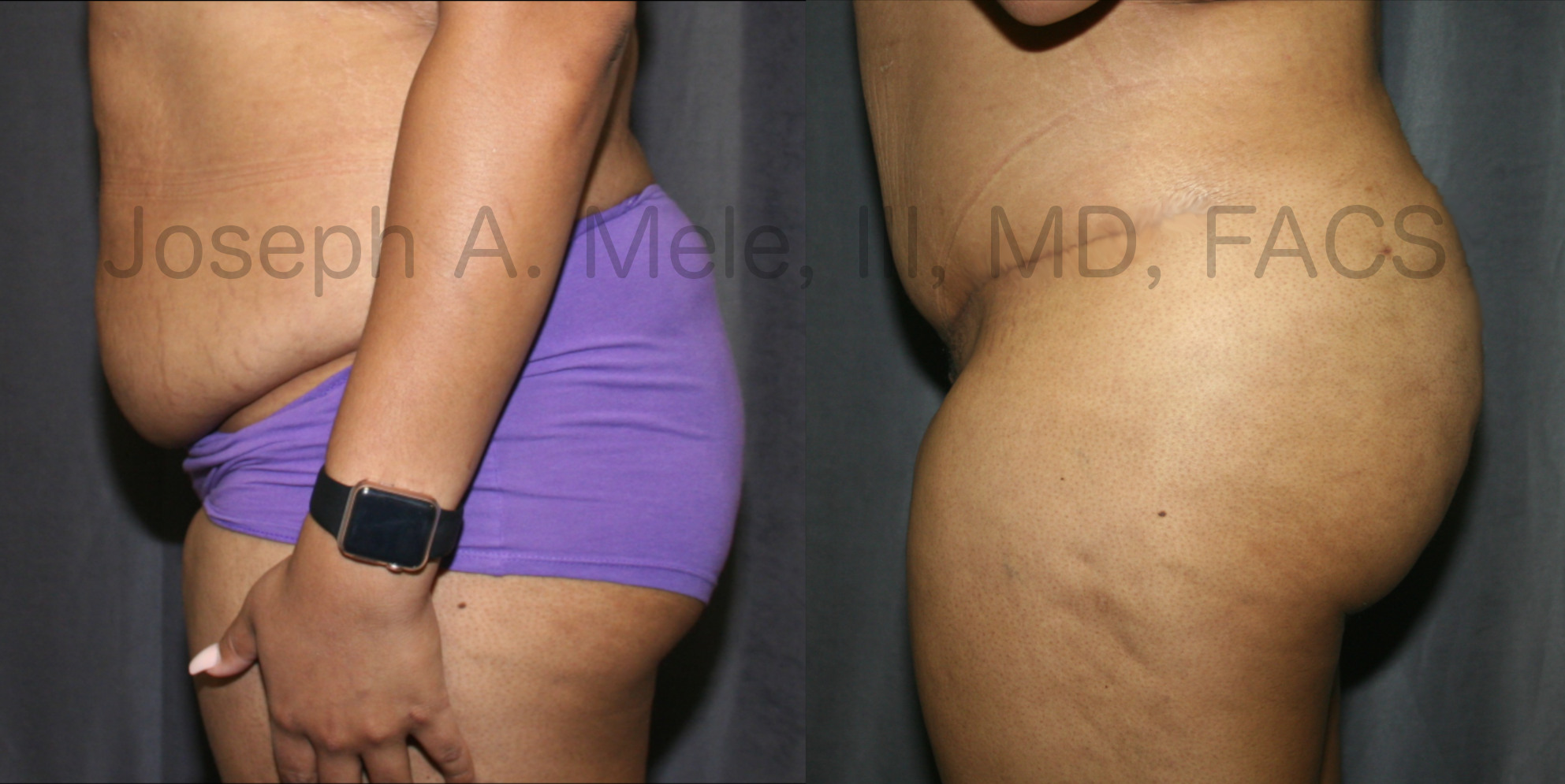 Brazilian Butt Lift with a Tummy Tuck before and after pictures. (BBL and Abdominoplasty)