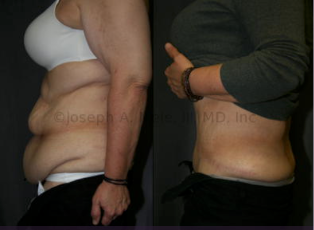 Post Bariatric Plastic Surgery - Body Lift