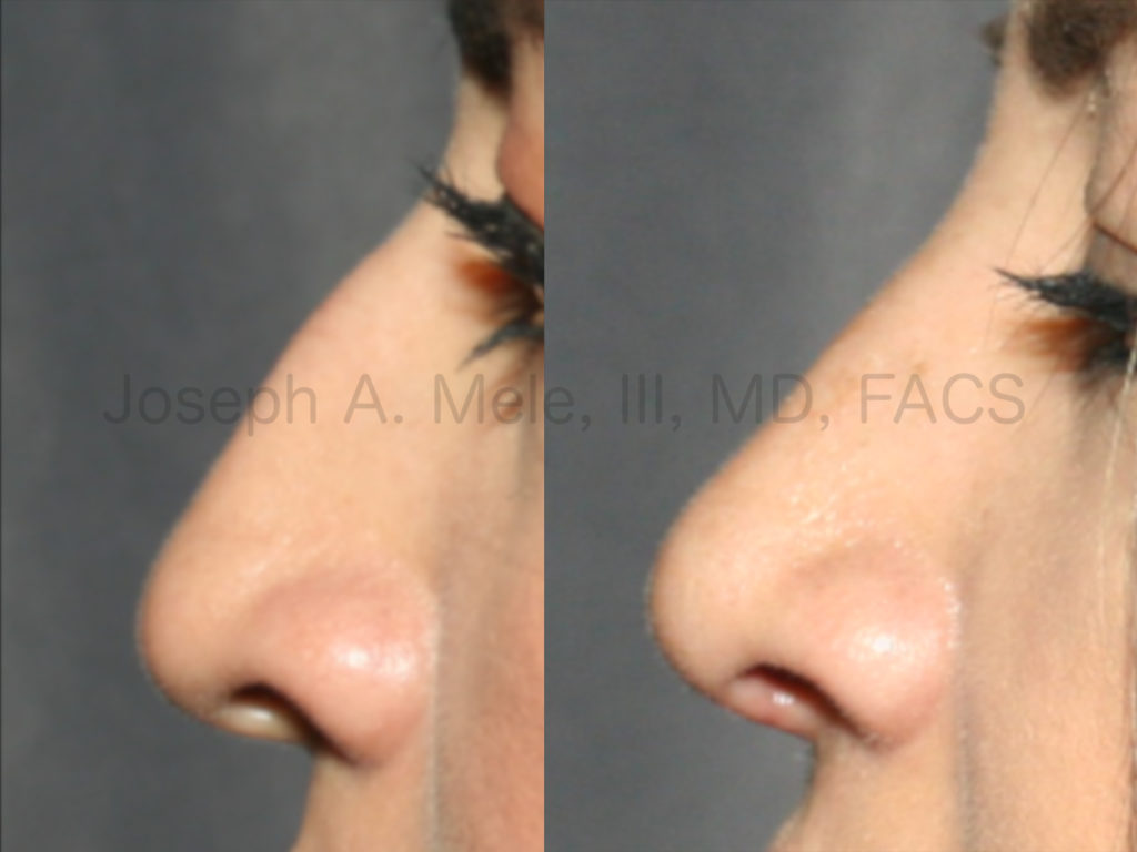 Rhinoplasty before and after pictures - removing the bump