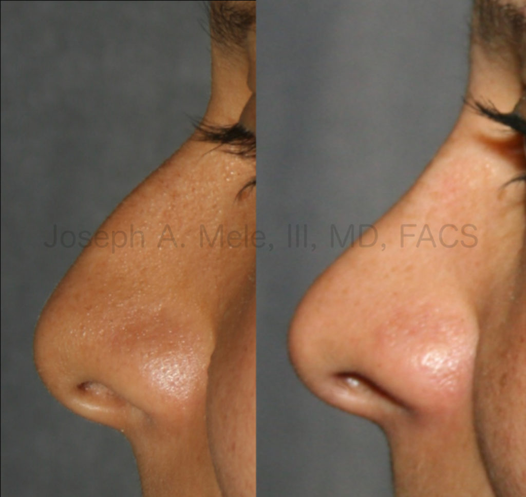 Rhinoplasty before and after pictures - raising the tip