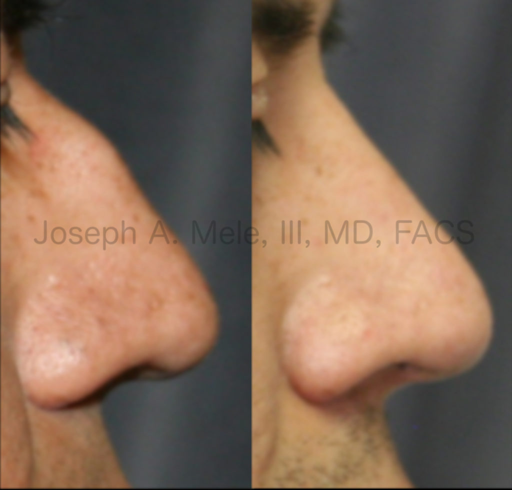 Rhinoplasty before and after pictures - removing big bump