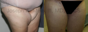 Thigh lift before and after pictures (thighplasty)