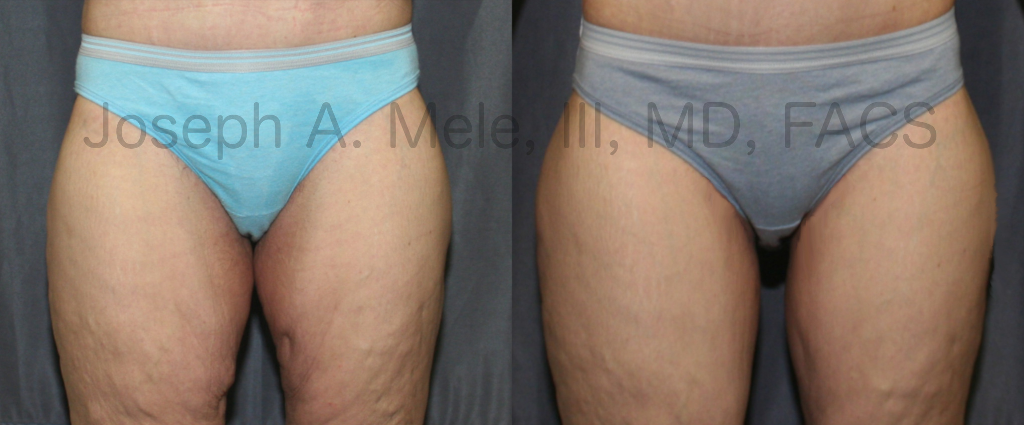 Thigh Lift before and after pictures (thighplasty after weight loss)