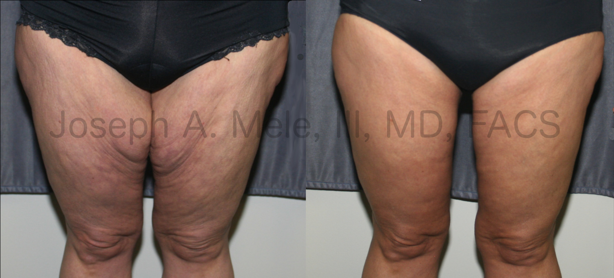 Thigh Lift before and after pictures (thighplasty after weight loss)