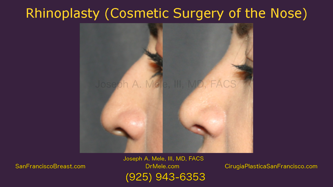 Rhinoplasty Videos Presentation featuring Nose Job before and after pictures