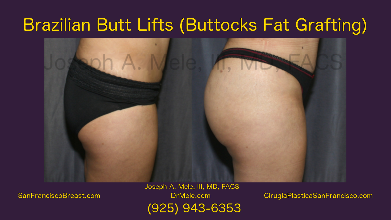 BBL video with Brazilian Butt Lift before and after photos