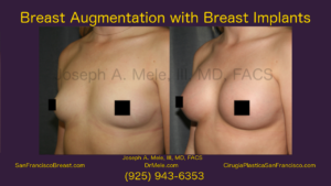 Breast Augmentation Before and After Video