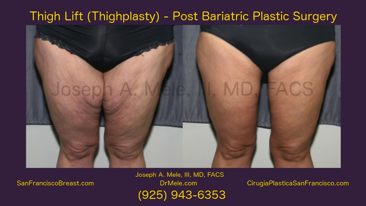 Thigh Lift video presentation with thighplasty before and after pictures with Dr. Joseph Mele