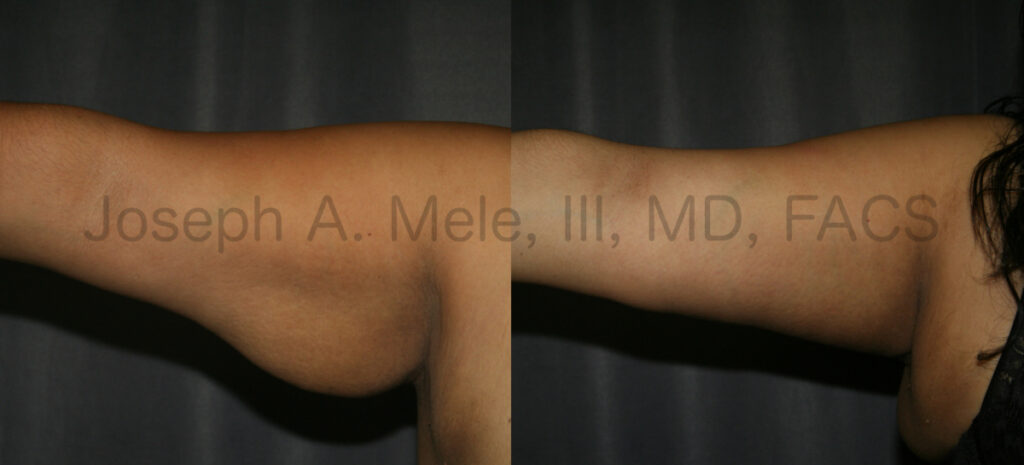 Arm Lift Before and After Pictures (Brachioplasty)