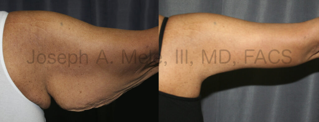 Brachioplasty Before and After Pictures (Arm Lift)