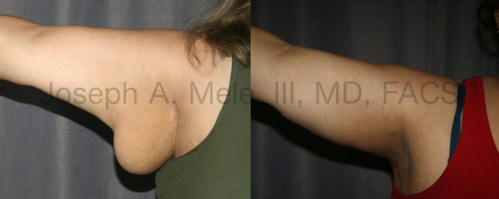 Brachioplasty Before and After Pictures (Arm Lift)