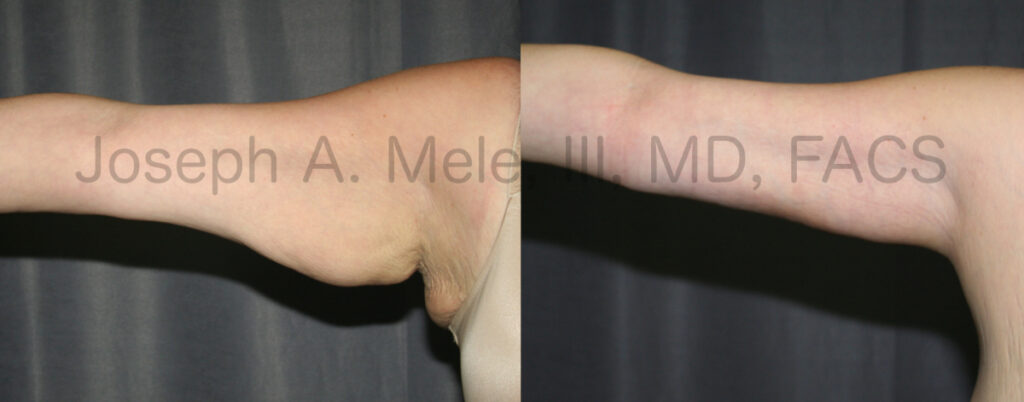 Arm Lift Before and After Pictures (Brachioplasty)