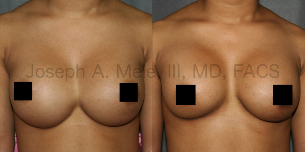 Breast Augmentation Revision for Symmastia (Uniboob) Before and After pictures