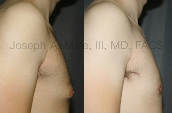 Gynecomastia reduction before and after photos of male breast reduction for tubular breasts.