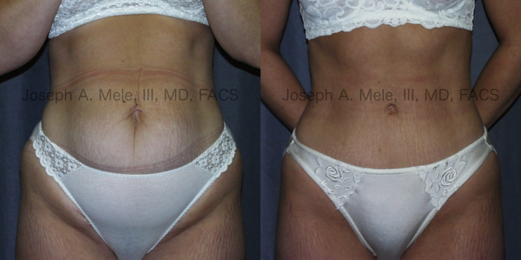 Tummy Tuck Before and After Pictures