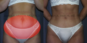 Abdominoplasty - Removal of Disproportional Fat