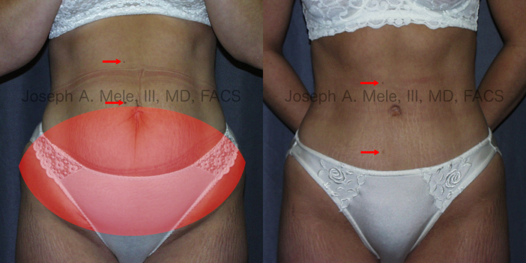 Abdominoplasty - removes any excess skin from the lower abdomen before and after pictures