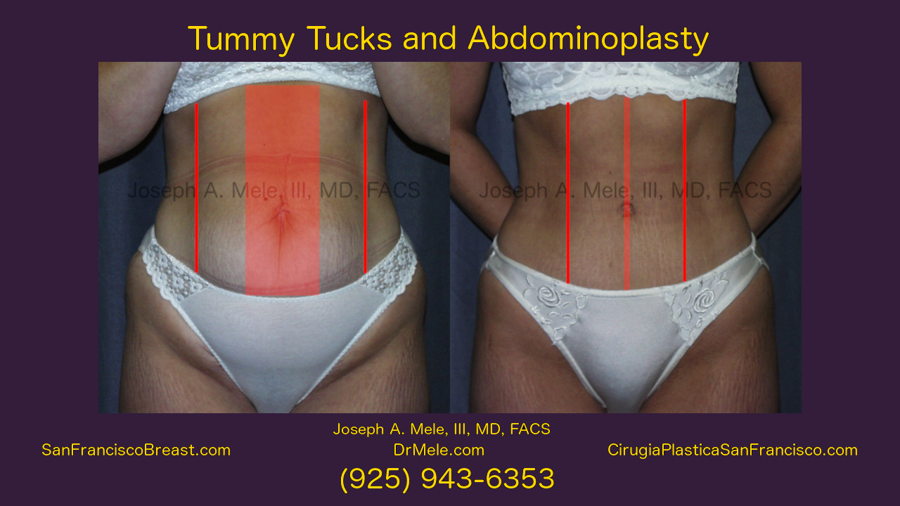 Tummy Tuck Before and After Pictures Video Presentation