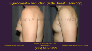 Gynecomastia Reduction Before and After Pictures Video (Male Breast Reduction)