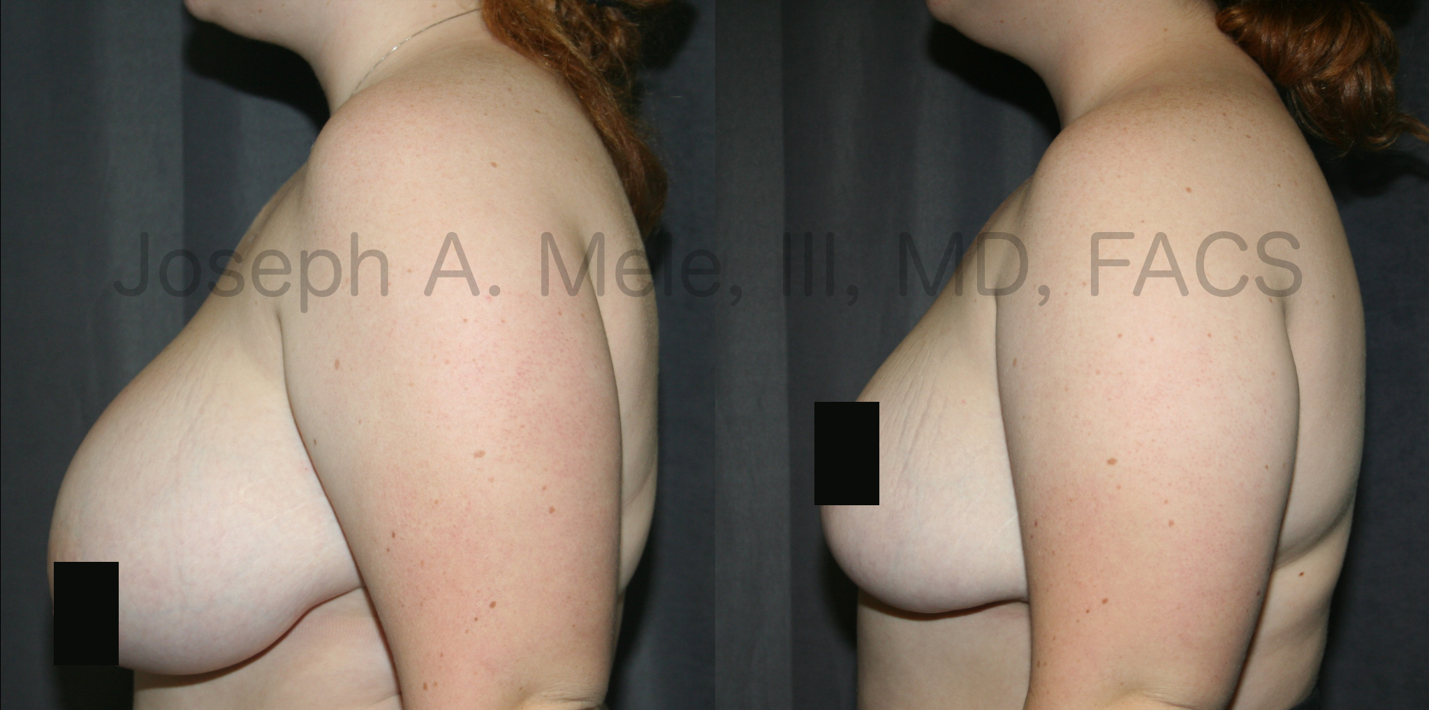 Breast Reduction Before and After Pictures