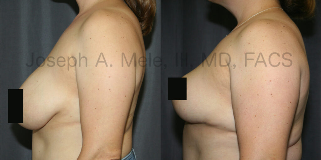 Breast Reduction Before and After Pictures