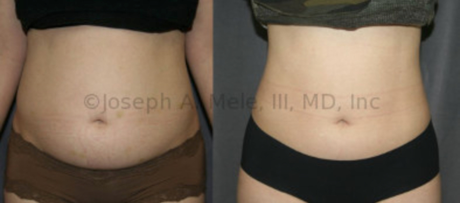 Liposuction of the Abdomen before and after pictures (Liposculpture)