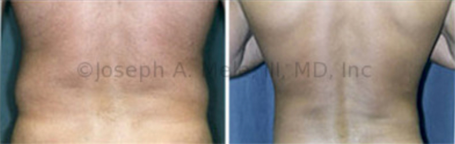 Liposuction of the Back before and after pictures (Male Love Handles)