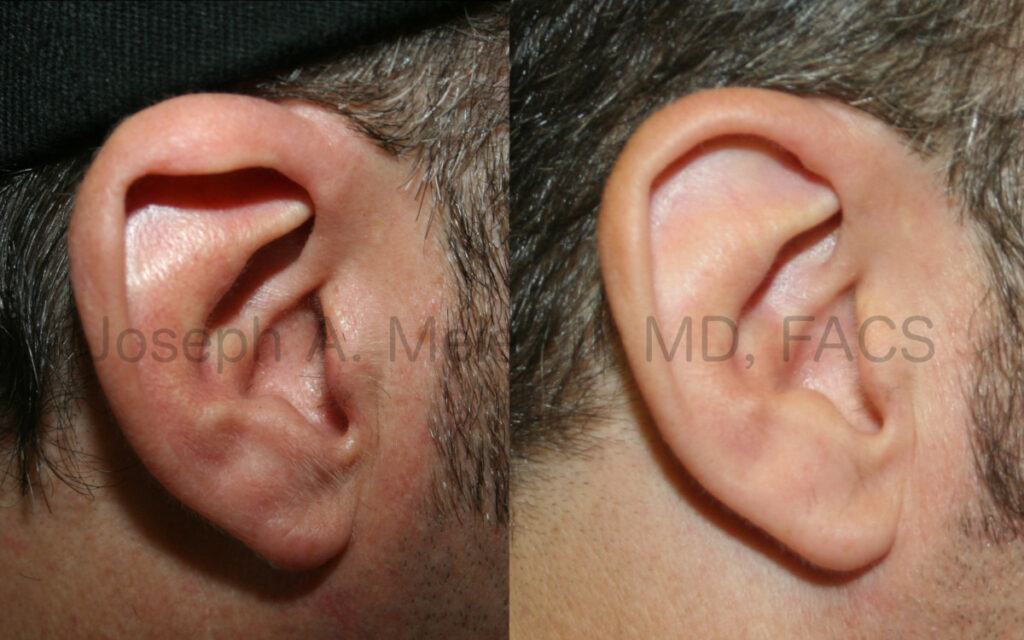 Cupped ear deformity correction via otoplasty before and after pictures