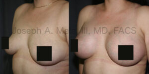 Breast Augmentation Before and After Pictures - Gummy Bear Breast Implants