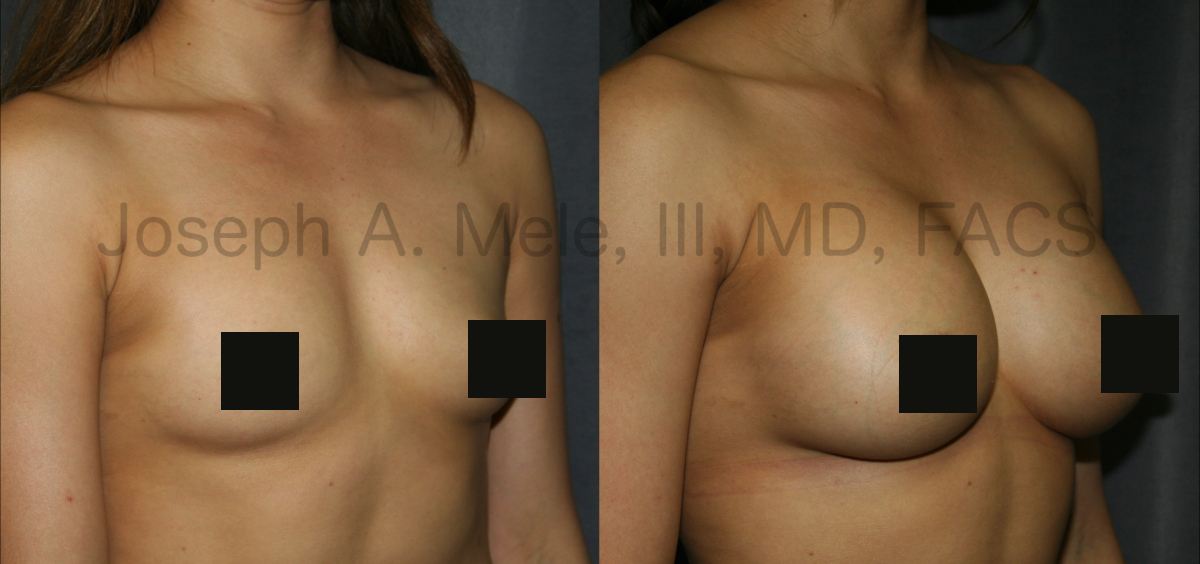 Breast Augmentation Before and After Pictures - Gummy Bear Breast Implants